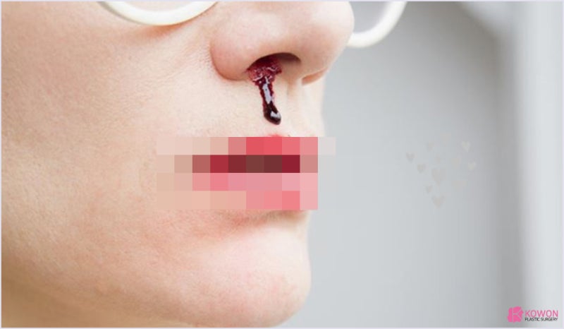 코피가안멈춰요 갑자기코피가나는이유 출혈 지혈 멈추는 법