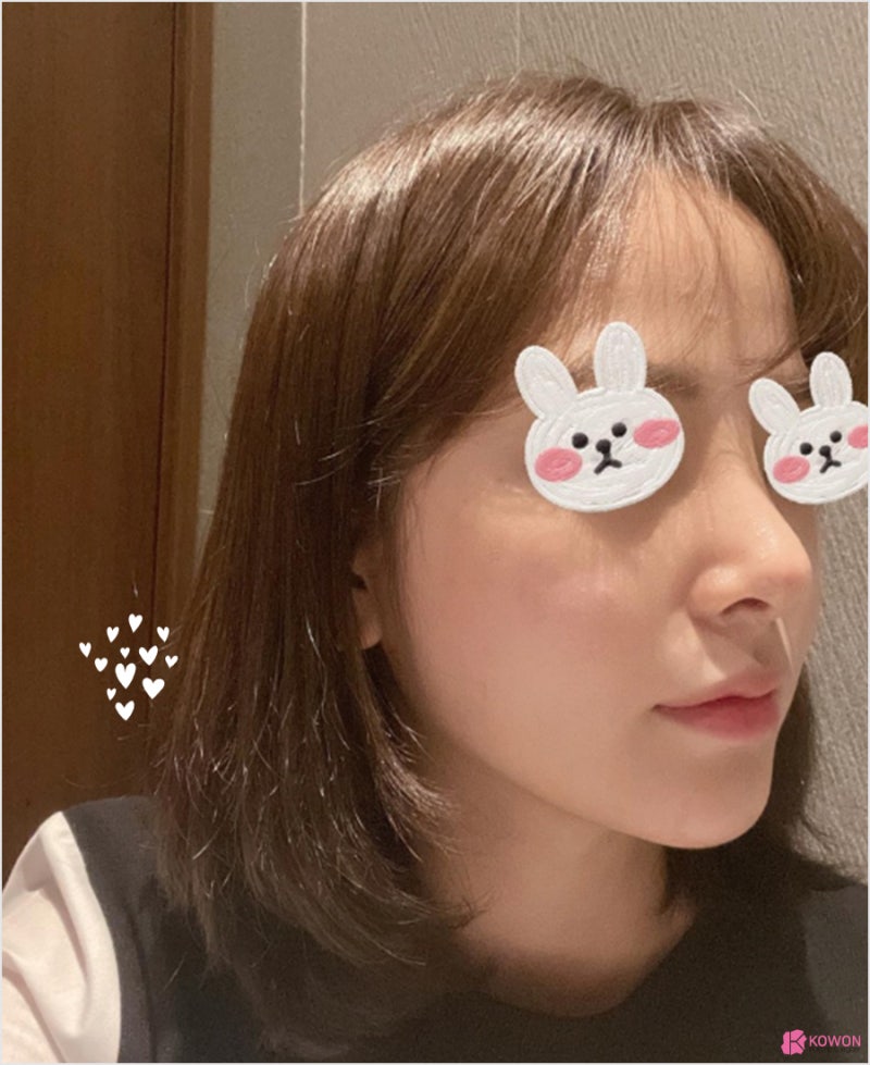 예쁜코 여자 콧대 라인 코필러후코성형 사례 붓기 회복 사진 6