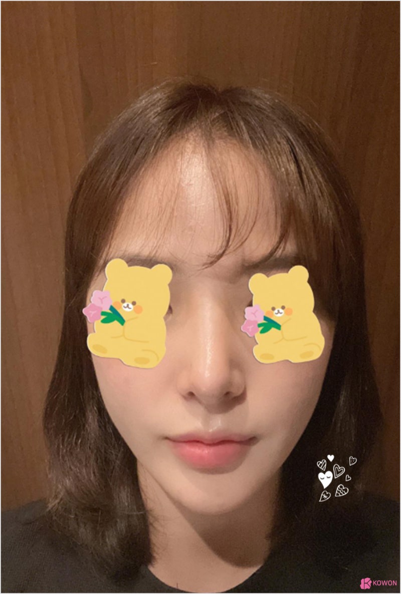 예쁜코 여자 콧대 라인 코필러후코성형 사례 붓기 회복 사진 8