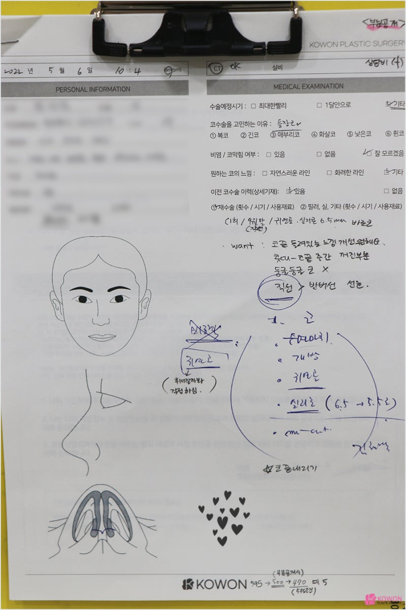 코재수술성형외과추천 돼지코모양 콤플렉스 해결 연골 비주