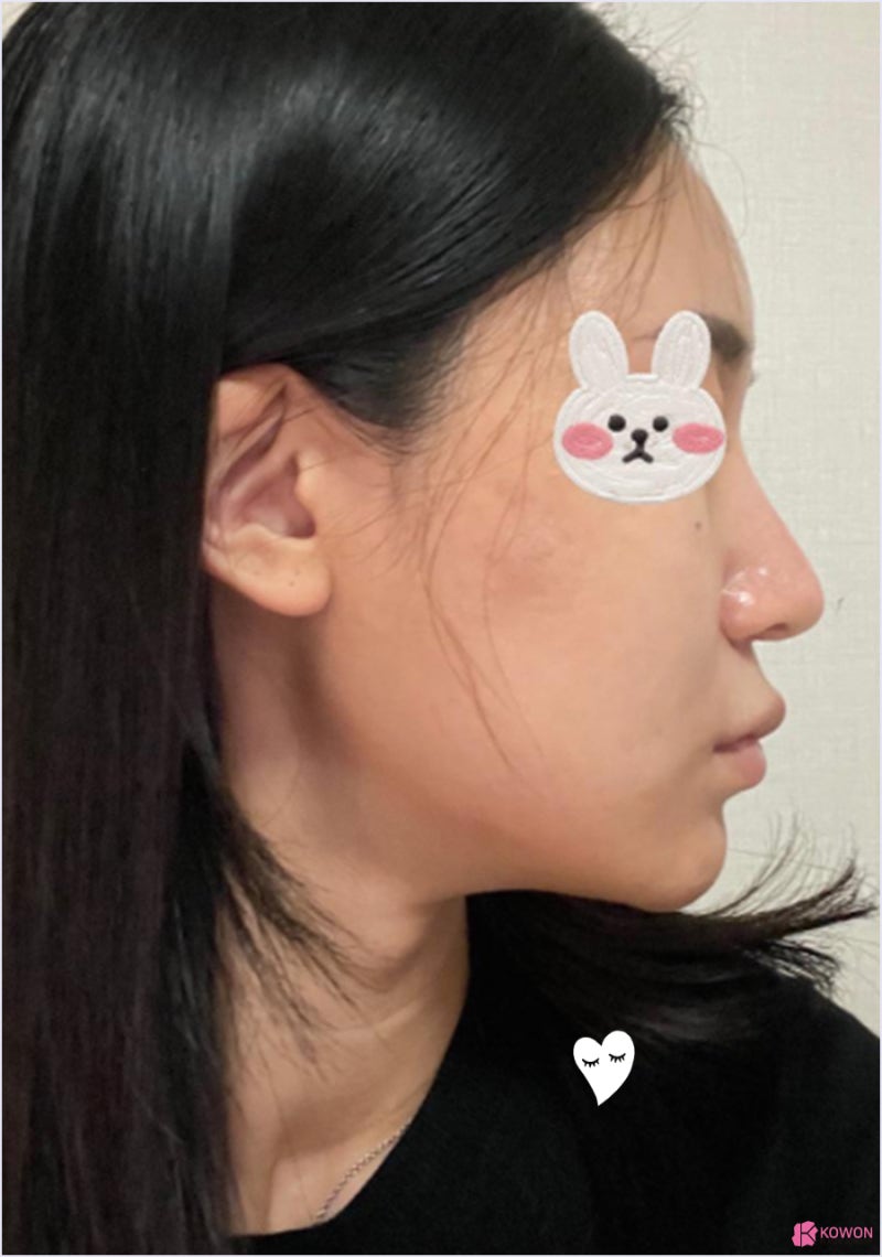 강남역성형외과 코성형재수술 코 끝 처짐 전후 비교 사진 5