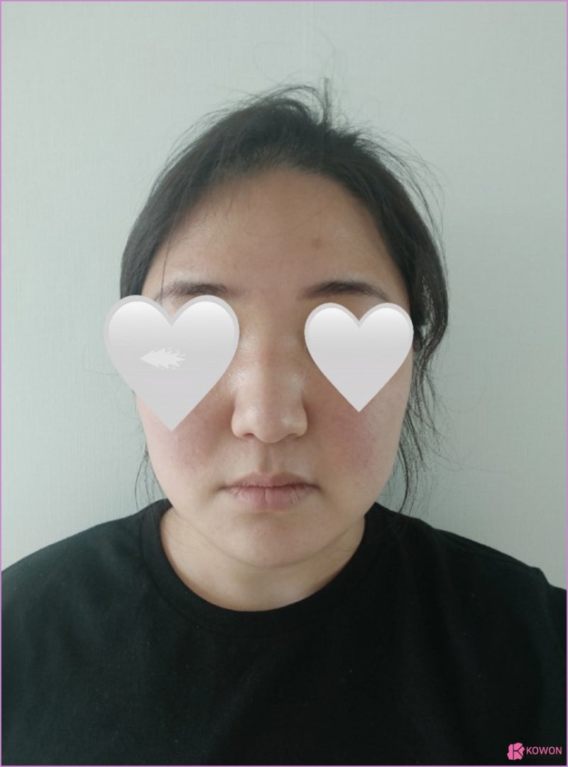 신사성형외과 복코코끝 전후 콤플렉스 콧대 붓기 사진 5