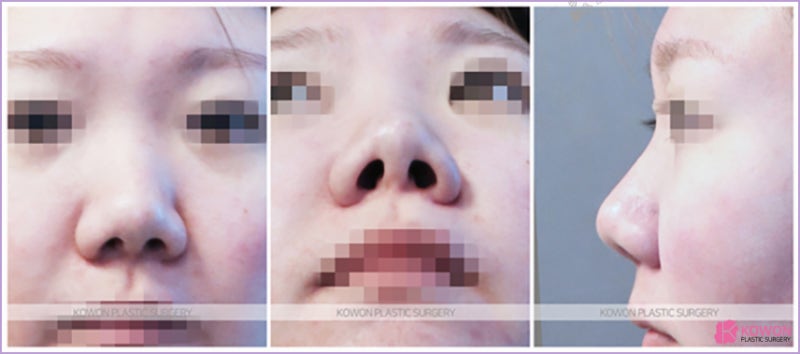 들창코수술 신논현코성형외과 짧은 돼지코 비대칭