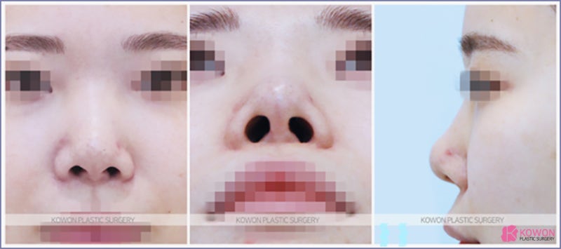 자가늑코성형 여자코재수술 자연스러운 예쁜 코