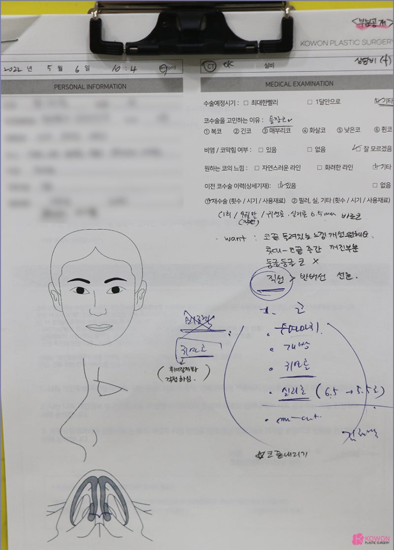 자연스러운코성형 성형티 콧구멍보임 재성형 직선코