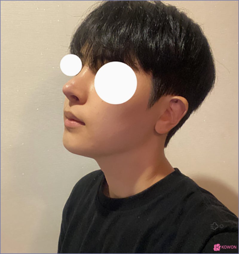 자연스러운코성형 성형티 콧구멍보임 재성형 직선코 사진 12