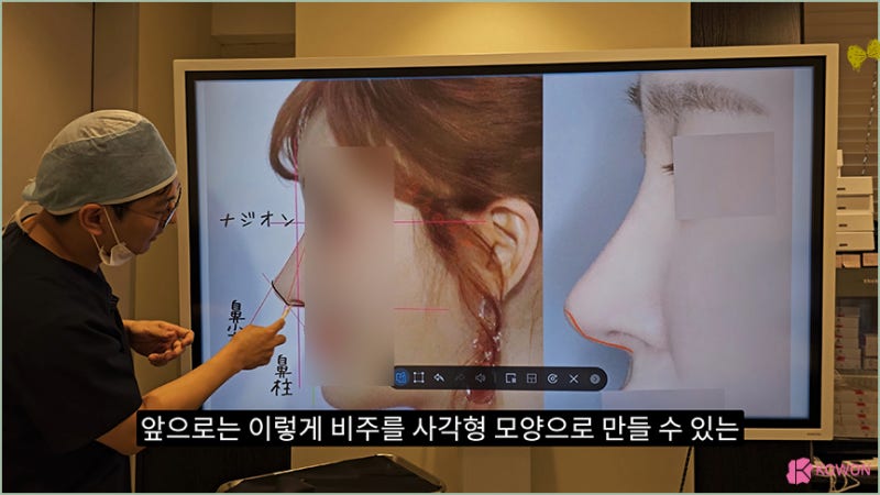 코원성형외과 코 코성형명의 예쁜코모양 비주 비순각 사진 12
