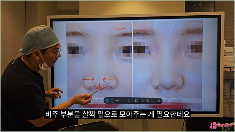 코원성형외과 코 코성형명의 예쁜코모양 비주 비순각 사진 6