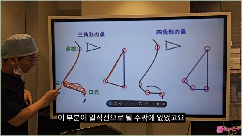 코원성형외과 코 코성형명의 예쁜코모양 비주 비순각 사진 9