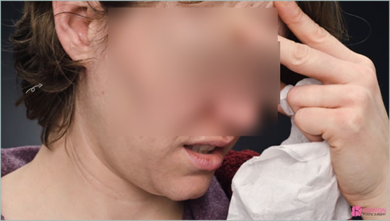 코딱지냄새 코딱지 피 생기는이유 세균 점막 뇌수막염 사진 3