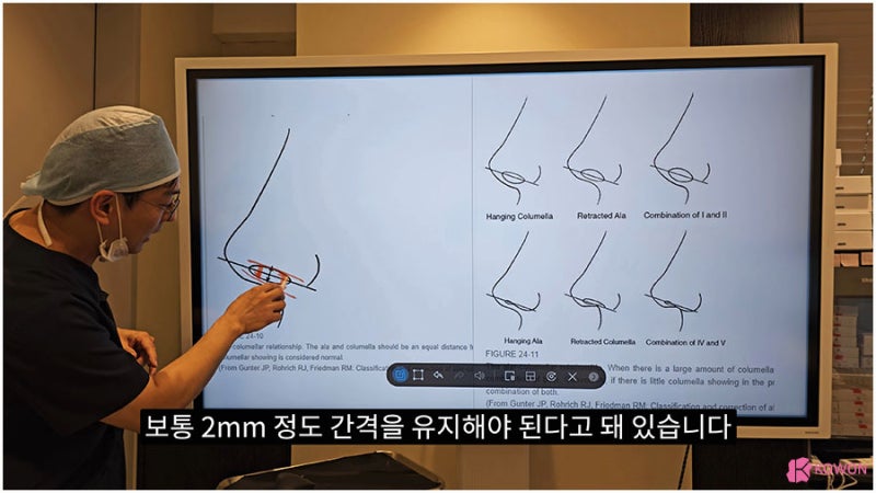 신사역근처성형외과 비주수술 코디자인 비순각 조화로움 사진 3