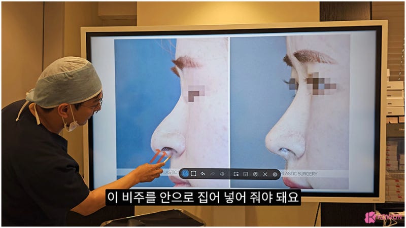 신사역근처성형외과 비주수술 코디자인 비순각 조화로움 사진 7