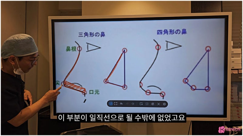 신사역근처성형외과 비주수술 코디자인 비순각 조화로움 사진 9