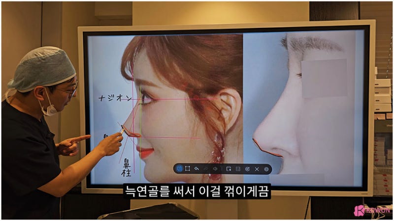 신사역근처성형외과 비주수술 코디자인 비순각 조화로움 사진 11