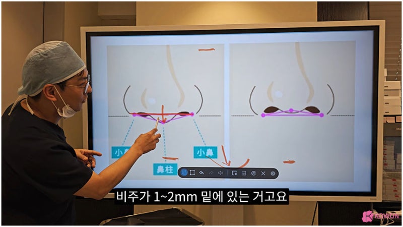 신사역근처성형외과 비주수술 코디자인 비순각 조화로움 사진 4