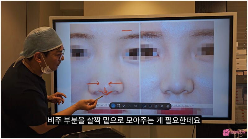 신사역근처성형외과 비주수술 코디자인 비순각 조화로움 사진 6