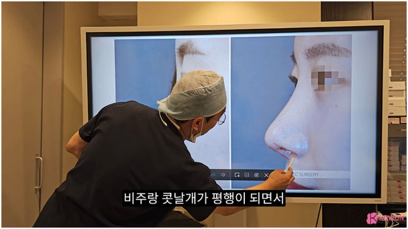 신사역근처성형외과 비주수술 코디자인 비순각 조화로움 사진 8