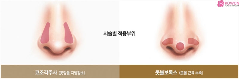 콧망울축소 방법 지방 주사 보톡스 차이 장단점 특징 사진 3