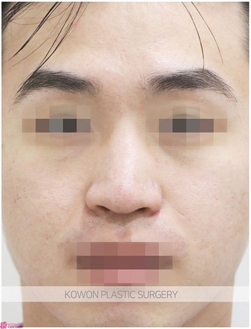 압구정로데오성형외과 남자코끝성형 전후 이미지 차이 후기 사진 5