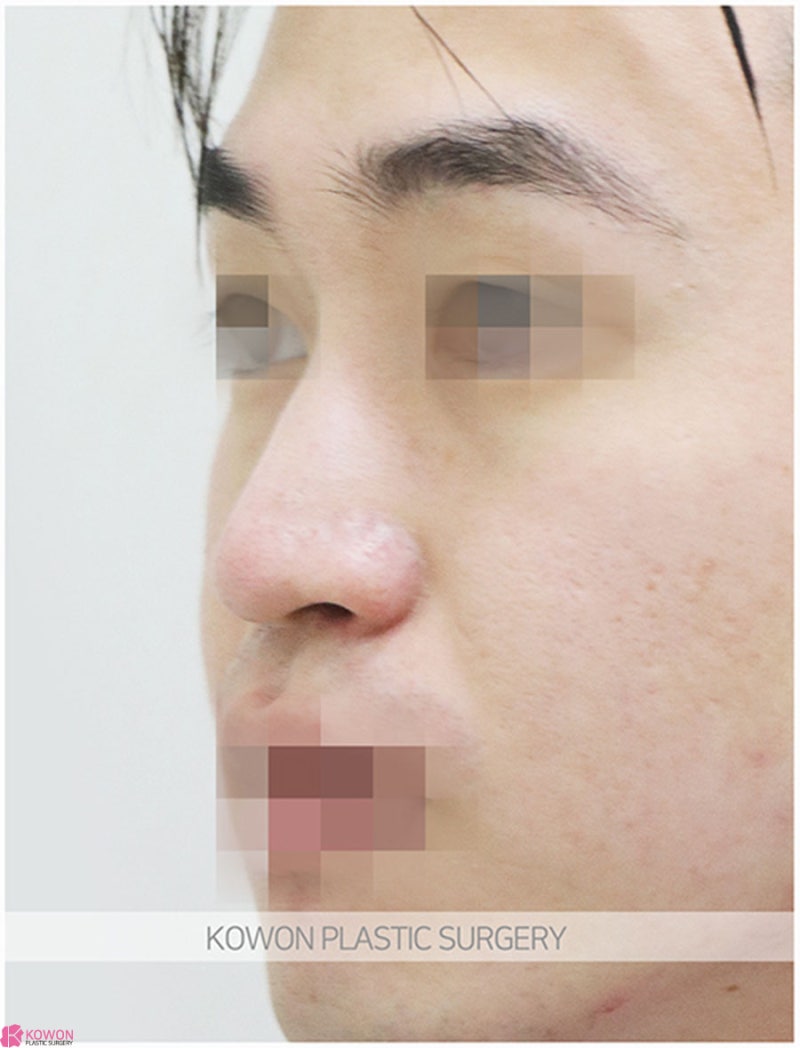 압구정로데오성형외과 남자코끝성형 전후 이미지 차이 후기 사진 3