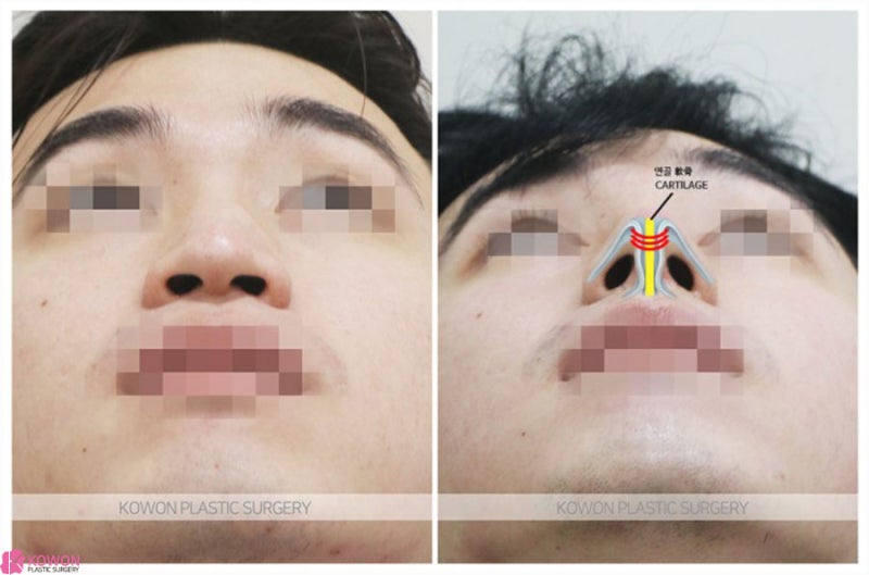 압구정로데오성형외과 남자코끝성형 전후 이미지 차이 후기 사진 8