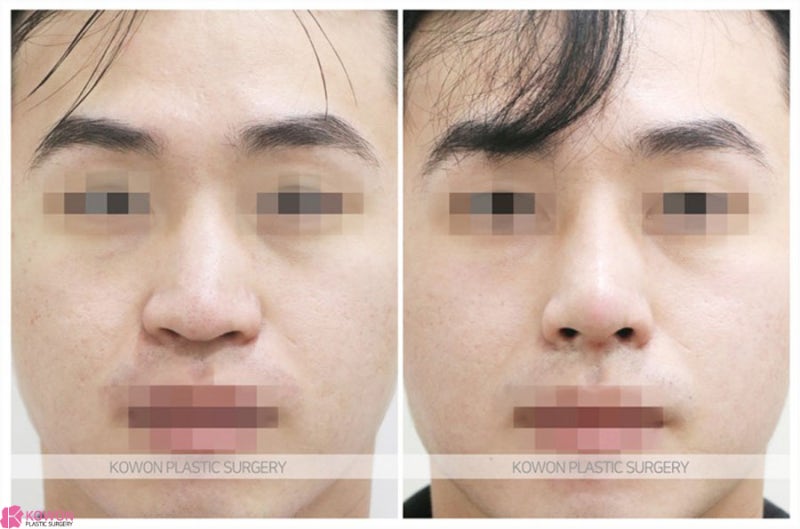 압구정로데오성형외과 남자코끝성형 전후 이미지 차이 후기 사진 12