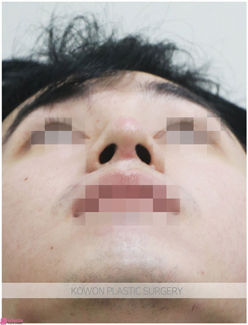압구정로데오성형외과 남자코끝성형 전후 이미지 차이 후기 사진 11