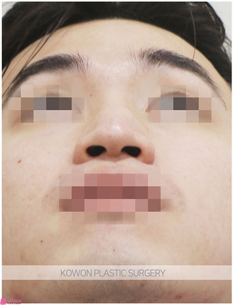 압구정로데오성형외과 남자코끝성형 전후 이미지 차이 후기 사진 7