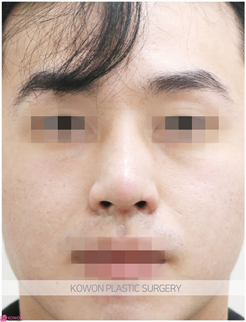 압구정로데오성형외과 남자코끝성형 전후 이미지 차이 후기 사진 6