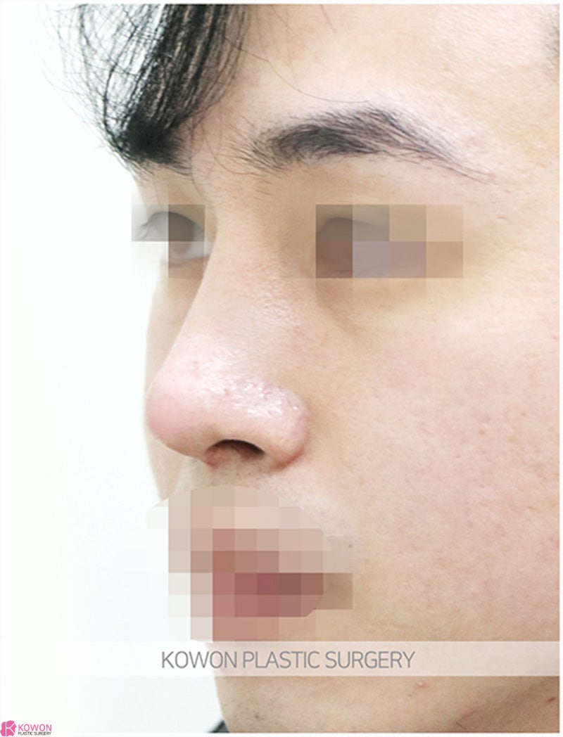 압구정로데오성형외과 남자코끝성형 전후 이미지 차이 후기 사진 4
