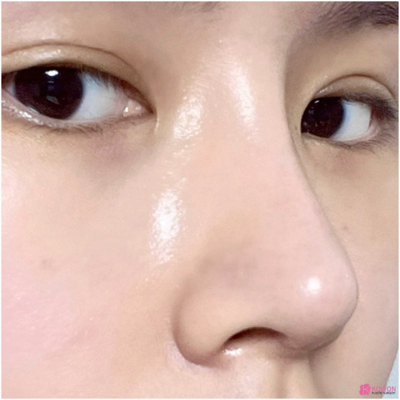 코재수술 전후 후기 코연골비침 부작용 개선한 방법