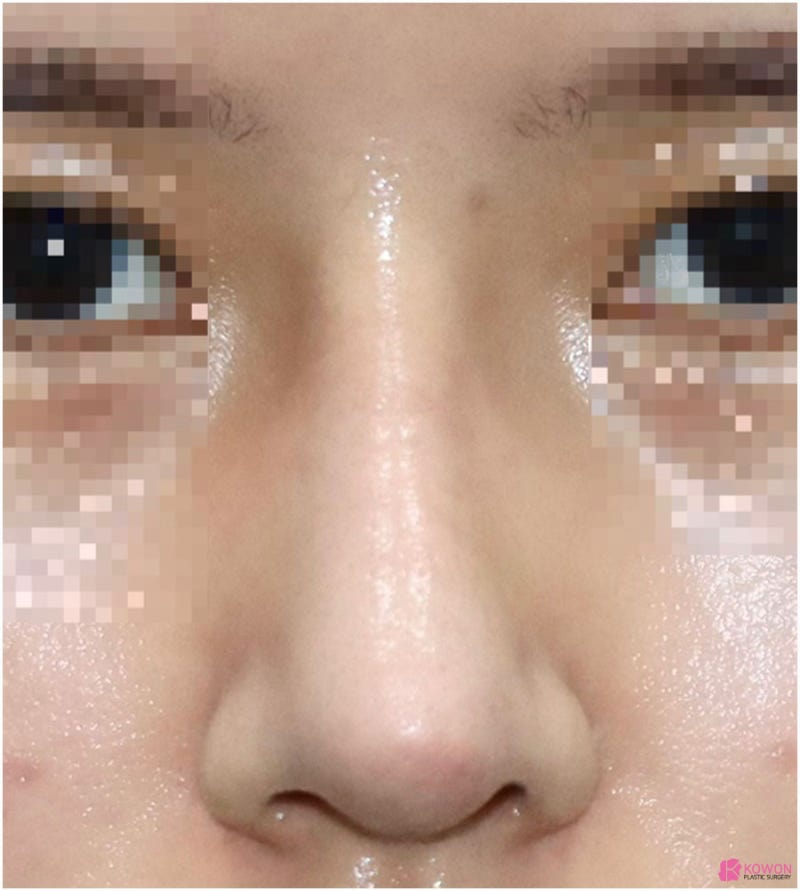 코재수술 전후 후기 코연골비침 부작용 개선한 방법