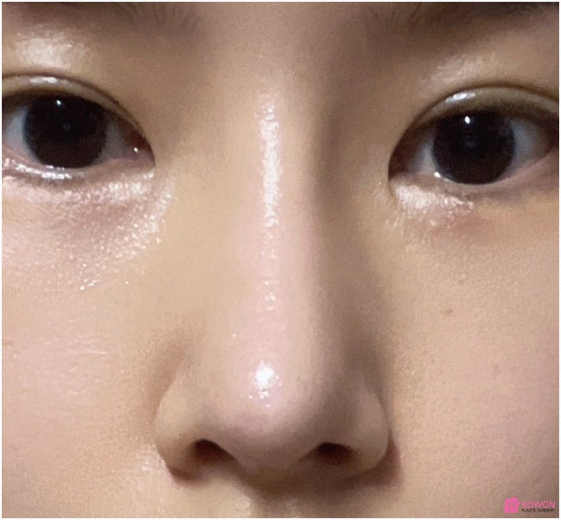 코재수술 전후 후기 코연골비침 부작용 개선한 방법 사진 3