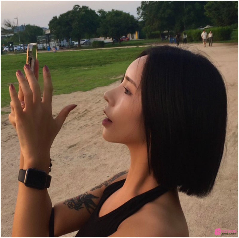코재수술 전후 후기 코연골비침 부작용 개선한 방법 사진 10