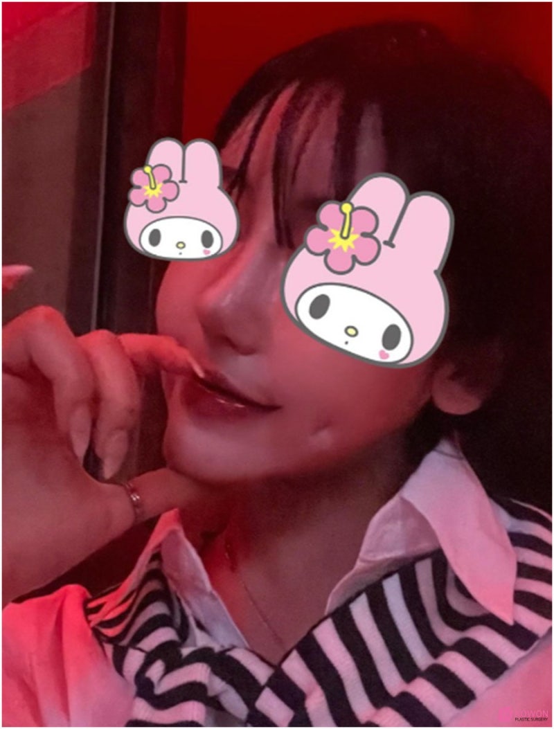 역삼동성형외과 수면마취코수술 개방 퍼지는코 뭉툭한 모양 사진 7