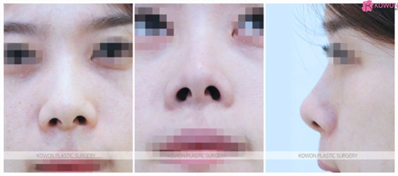 들창코 코끝수술 필러 제거 코끝연장 대칭 맞추기