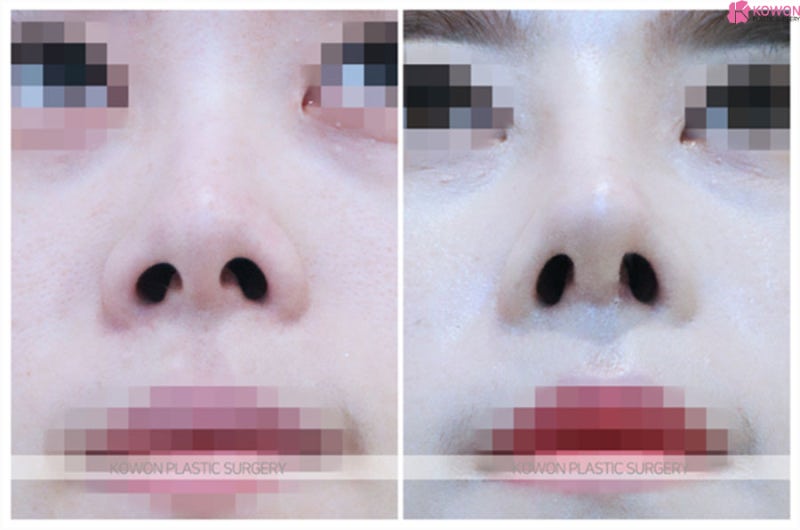 들창코 코끝수술 필러 제거 코끝연장 대칭 맞추기 사진 5