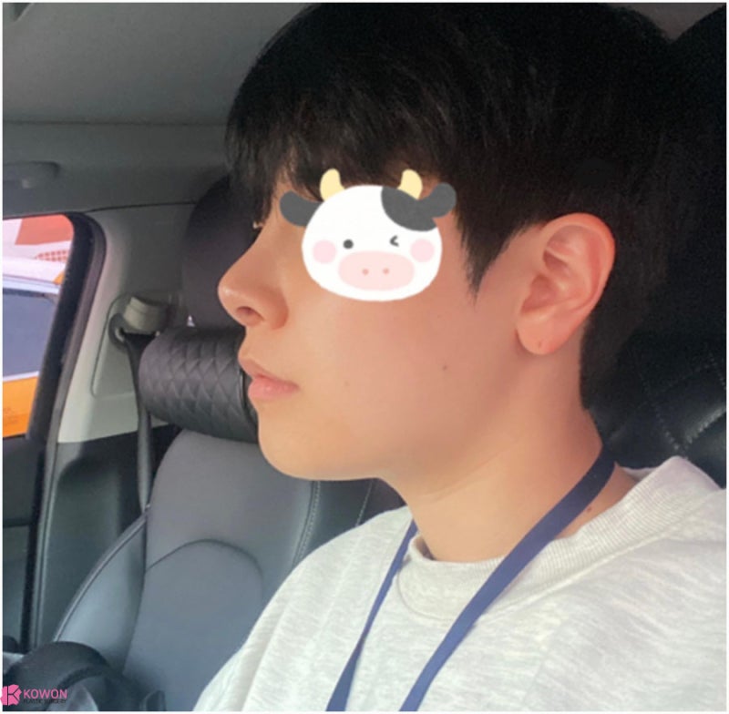 강남구청역성형외과 짝짝이콧구멍 교정 코끝내리는수술 사진 5