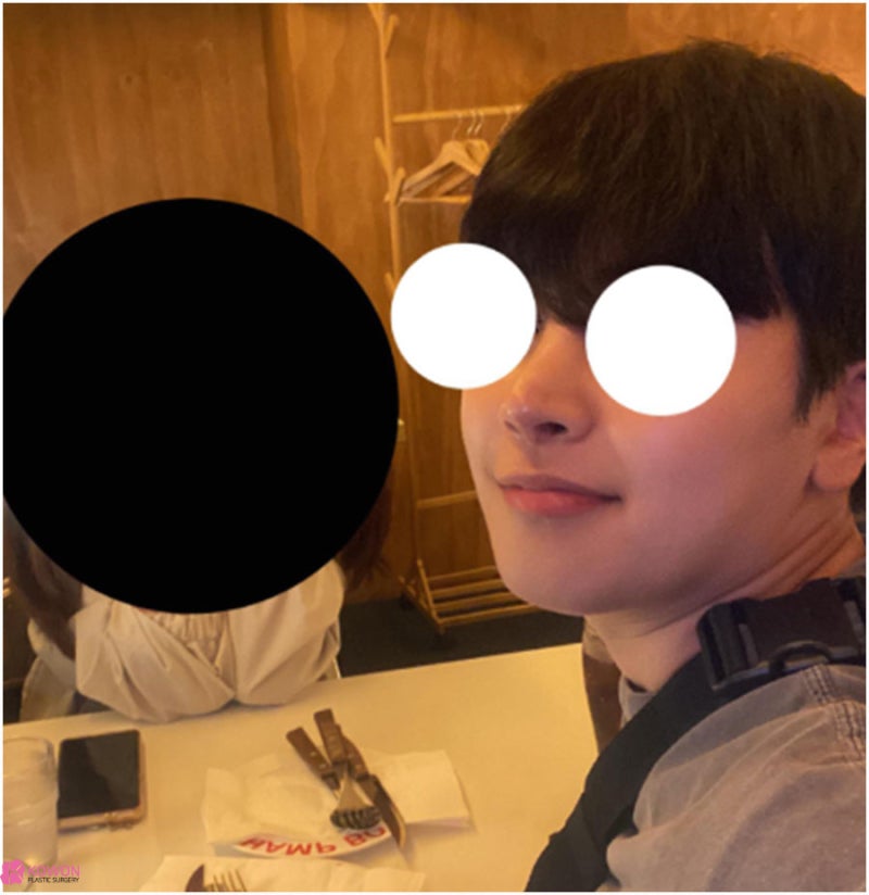 강남구청역성형외과 짝짝이콧구멍 교정 코끝내리는수술 사진 13