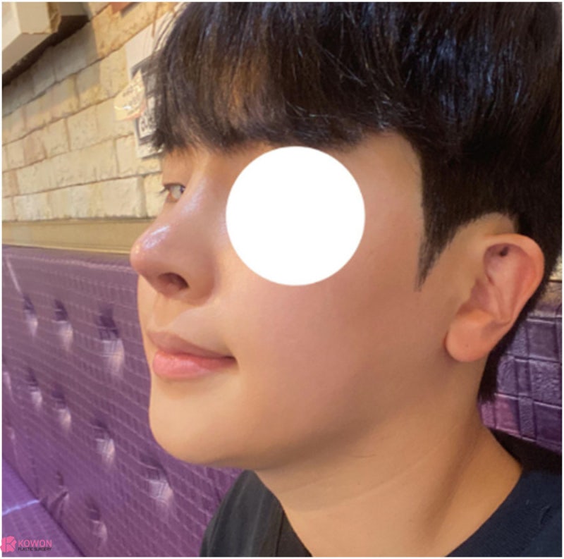 강남구청역성형외과 짝짝이콧구멍 교정 코끝내리는수술 사진 14