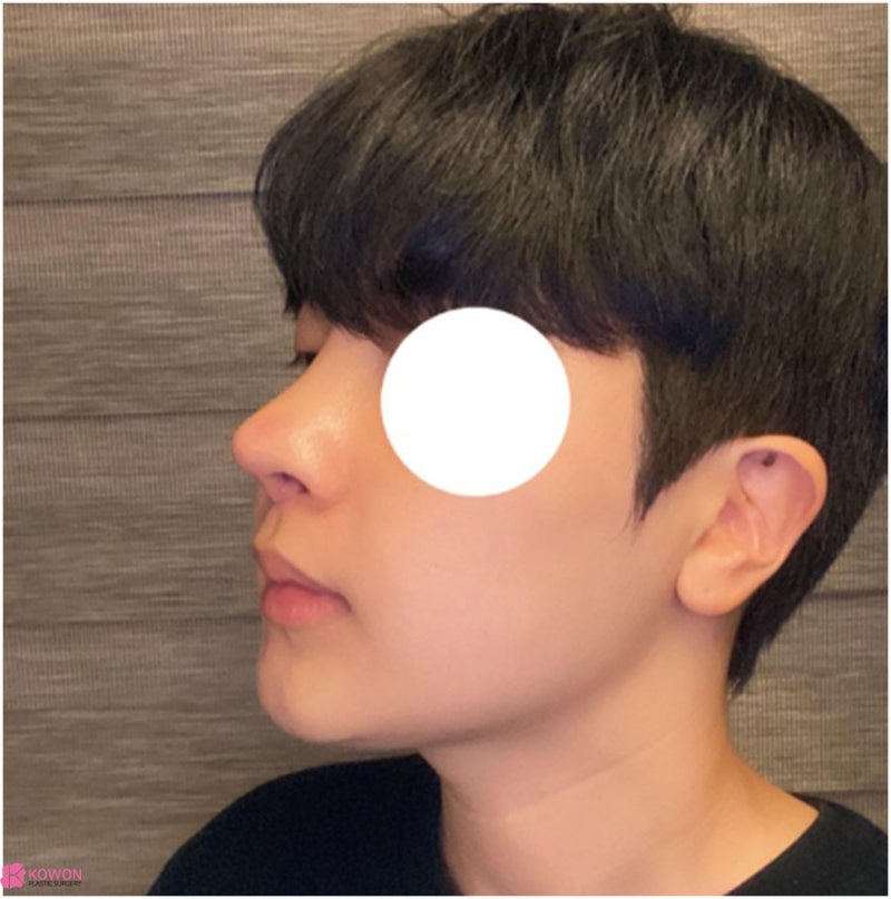 강남구청역성형외과 짝짝이콧구멍 교정 코끝내리는수술 사진 9