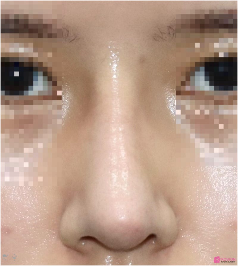코재수술후기 성형티 코성형부작용염증 논현성형외과