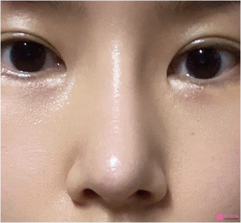 코재수술후기 성형티 코성형부작용염증 논현성형외과 사진 3