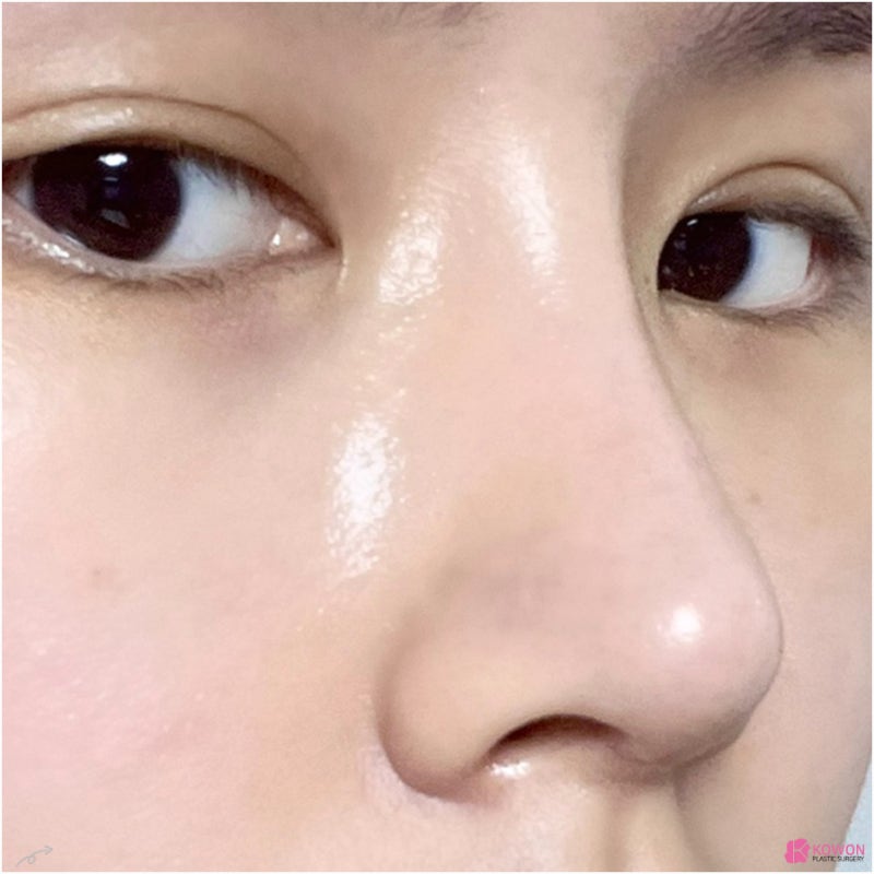 코재수술후기 성형티 코성형부작용염증 논현성형외과