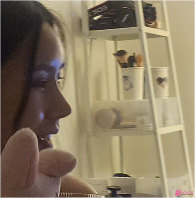 코재수술후기 성형티 코성형부작용염증 논현성형외과 사진 9