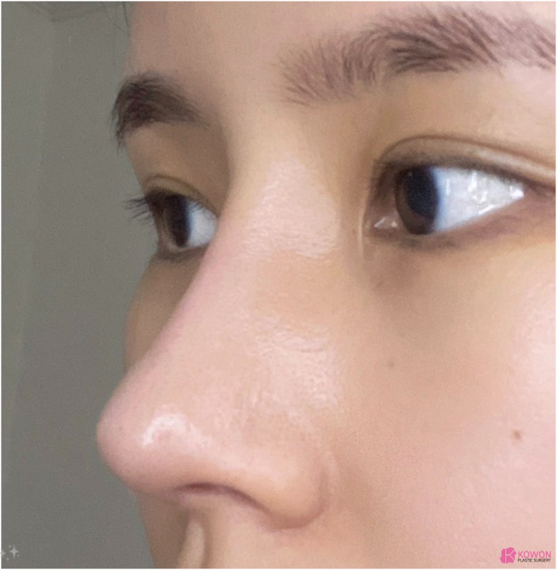 코재수술후기 성형티 코성형부작용염증 논현성형외과 사진 4