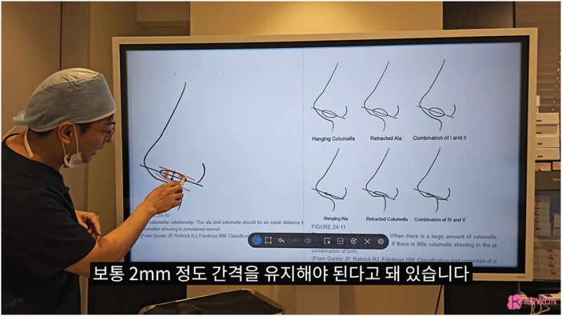 비주 처짐 콧날개 모양 수술 강남코성형외과 사진 3