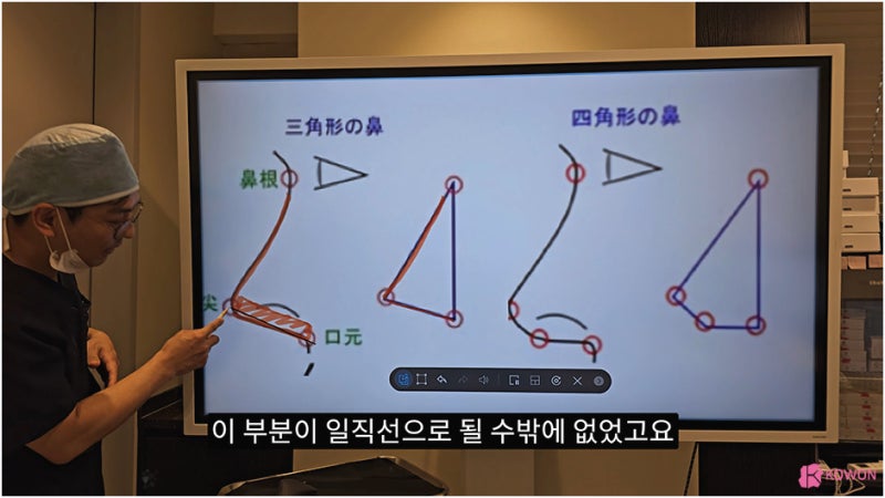 비주 처짐 콧날개 모양 수술 강남코성형외과 사진 9