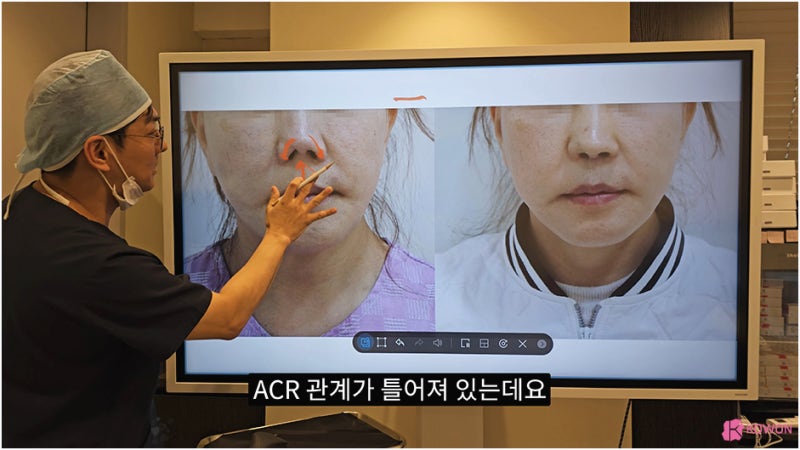 비주 처짐 콧날개 모양 수술 강남코성형외과 사진 5