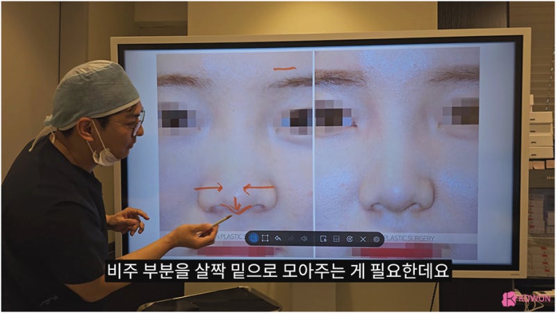 비주 처짐 콧날개 모양 수술 강남코성형외과 사진 6